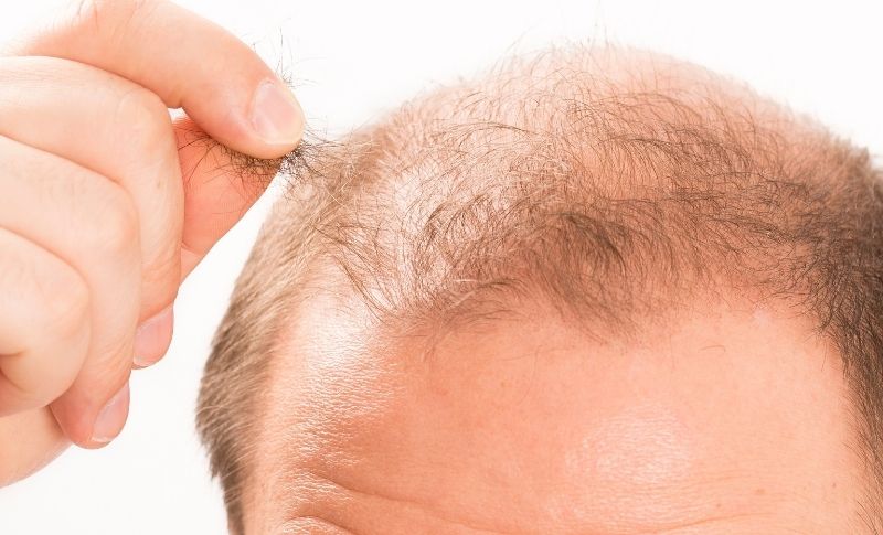 Androgenetic alopecia in men overview