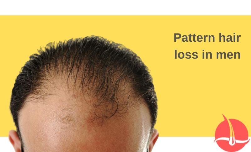 Androgenetic alopecia in men overview