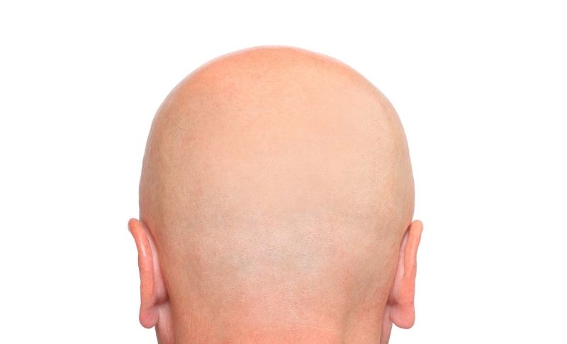 Baldness - Inflammation in androgenetic alopecia