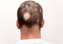 Effects of androgens in male androgenetic alopecia