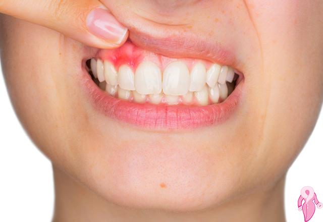 Herbal Treatment of Gingival Recession, Natural Remedy