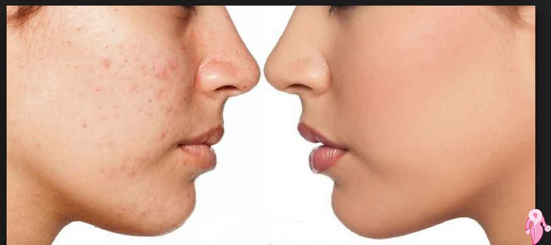 Natural Remedy for Pimples