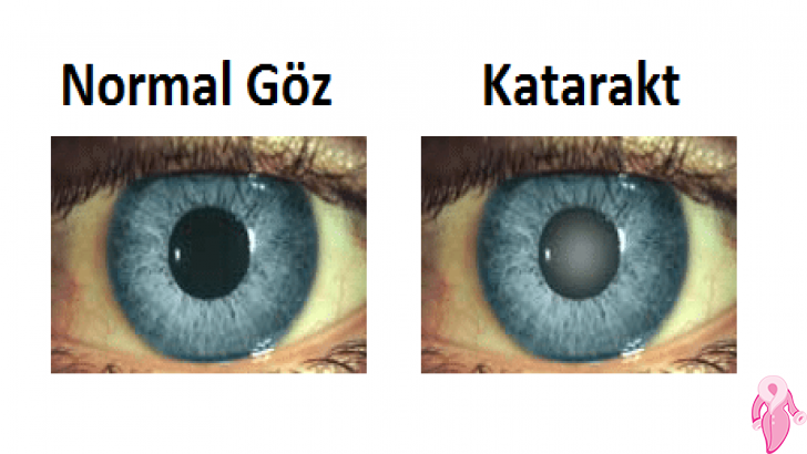 What are the Symptoms of Cataract, How to Understand? Treatment