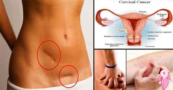 What are the Symptoms of Cervical Cancer?