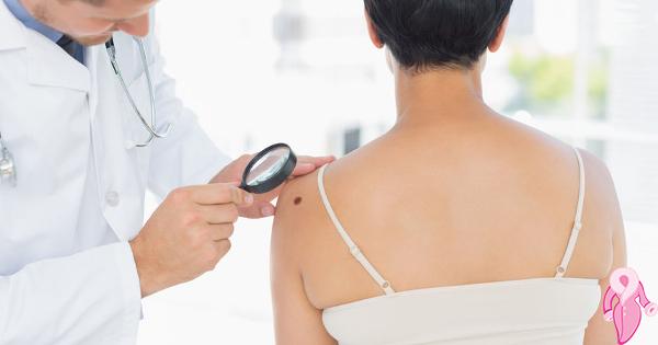What is Malignant Melanoma, Its Symptoms and Stages?