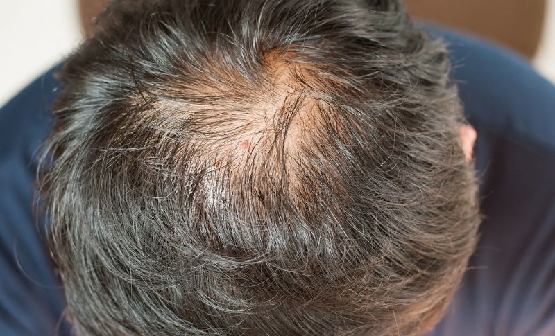 How Effective Are Hair Loss Products?