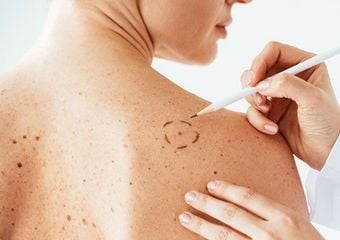 Beware of skin cancer!