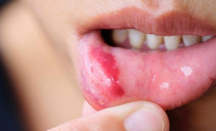 What is mouth cancer, a symptom of non-healing mouth sores!
