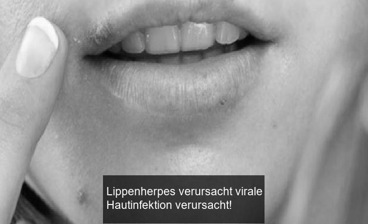 Lippenherpes verursacht virale Hautinfektion verursacht!