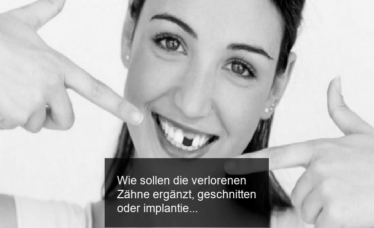 Wie sollen die verlorenen Zähne ergänzt, geschnitten oder implantiert werden? Experten erklären!
